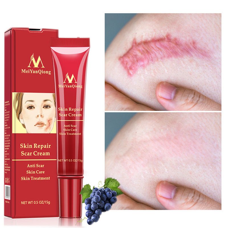 Acne scar removal cream - exquisiteblur