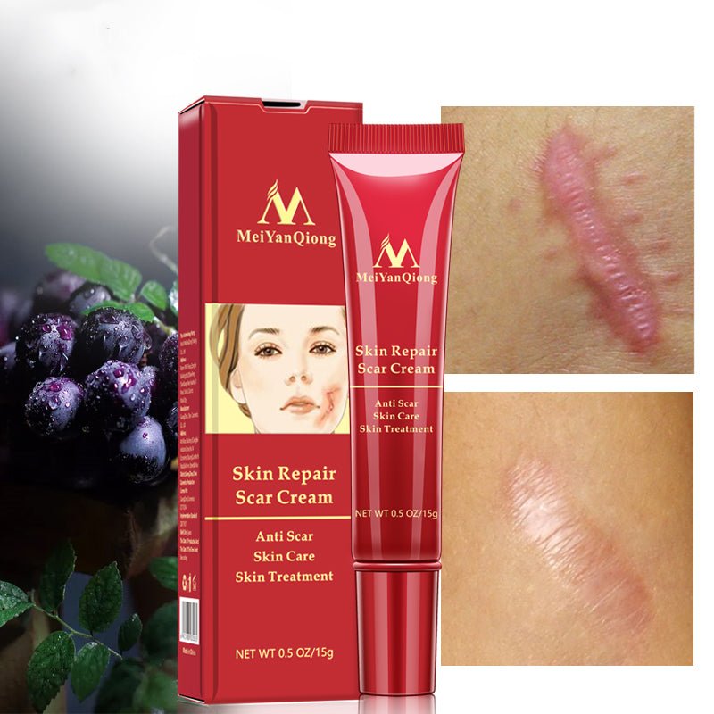 Acne scar removal cream - exquisiteblur